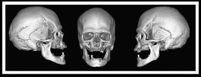 Vistas de los lados derecho, frontal e izquierdo de la reconstrucción en 3D del cráneo a partir de la tomografía.