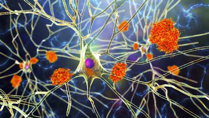 Ilustración de placas de amiloide de la enfermedad de alzhéimer en neuronas.